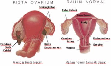 kista ovarium
