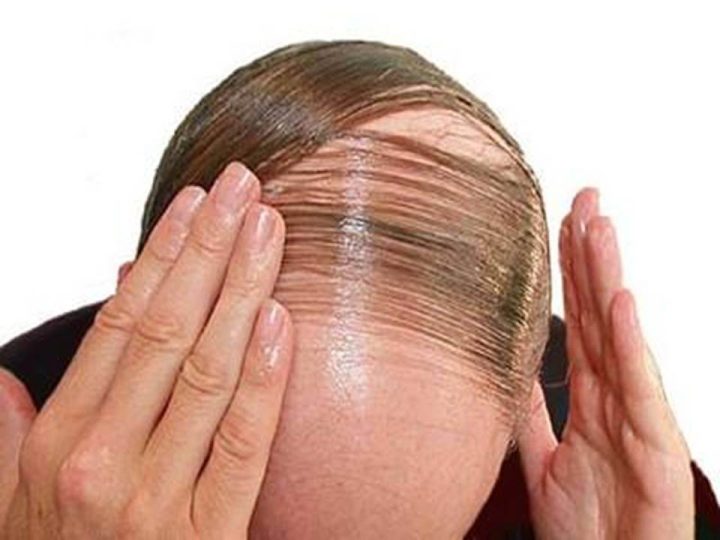 mengatasi rambut rontok