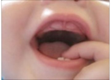 tanda gigi tumbuh pada bayi