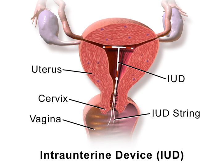 Mencegah kanker serviks dengan IUD